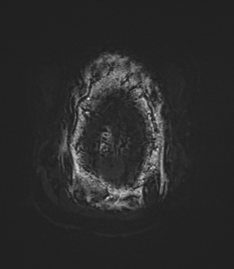 Arachnoid cyst with subdural hematoma (Radiopaedia 85892-101743 Axial SWI 88).png