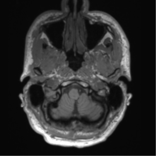 File:Arachnoid cyst with subdural hematoma (Radiopaedia 85892-101743 Axial T1 14).png