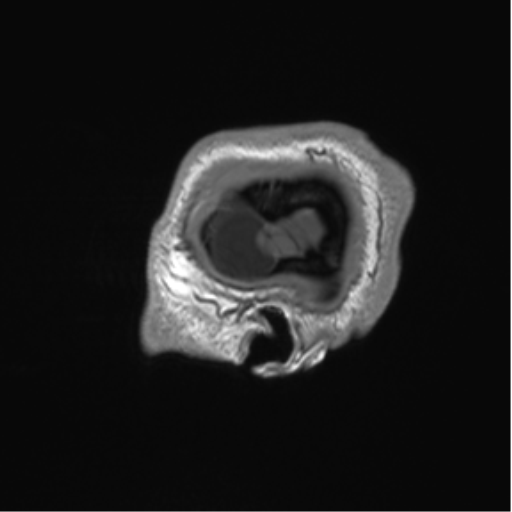 File:Arachnoid cyst with subdural hematoma (Radiopaedia 85892-101743 Sagittal T1 8).png