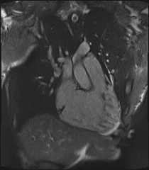 Arrhythmogenic right ventricular cardiomyopathy (Radiopaedia 57972-64966 CINE R2 SSFP 35).jpg