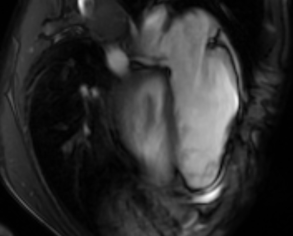 Arrhythmogenic right ventricular cardiomyopathy (Radiopaedia 69564-79464 4ch cine 114).jpg