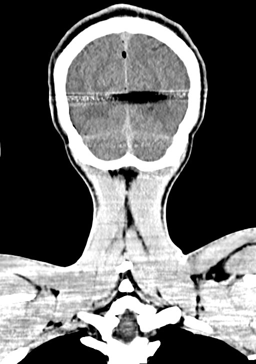 Arrow injury to the brain (Radiopaedia 72101-82607 Coronal non-contrast 62).jpg