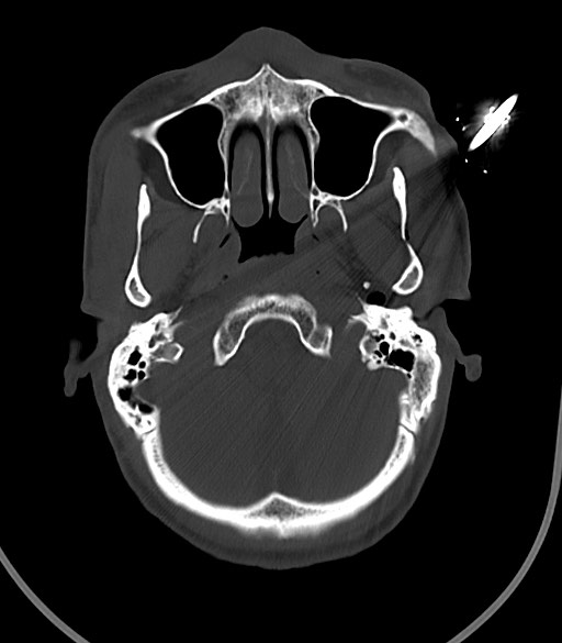 Arrow injury to the face (Radiopaedia 73267-84011 Axial bone window 42).jpg
