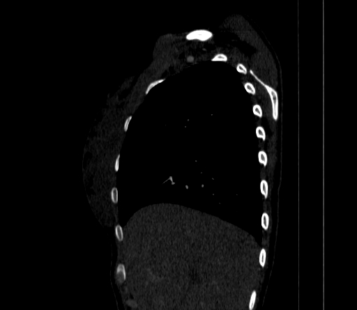 File:Arteria lusoria (Radiopaedia 88528-105192 C 27).jpg
