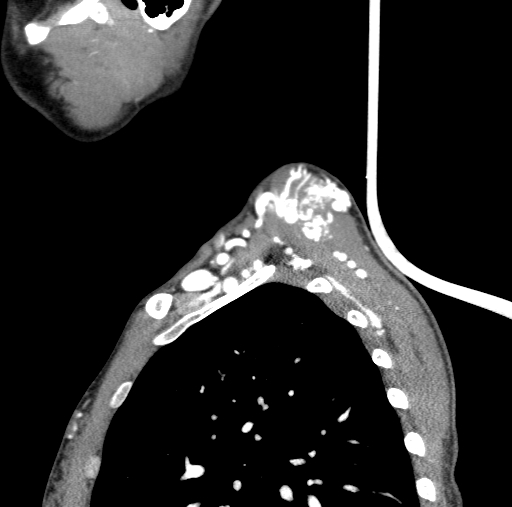 Arteriovenous malformation of the neck (Radiopaedia 53935-60062 C 11).jpg