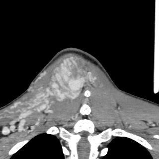 Arteriovenous malformation of the neck (Radiopaedia 53935-60062 D 51).jpg