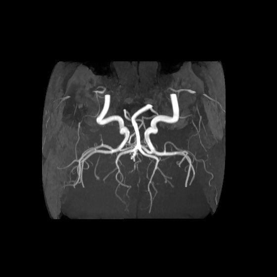 File:Artery of Percheron infarct (Radiopaedia 40966-43676 F 52).jpg