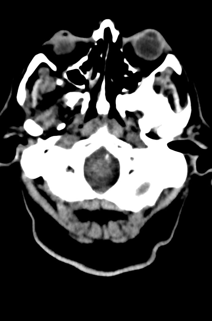 Artery of Percheron infarction (Radiopaedia 80613-94202 Axial non-contrast 31).jpg