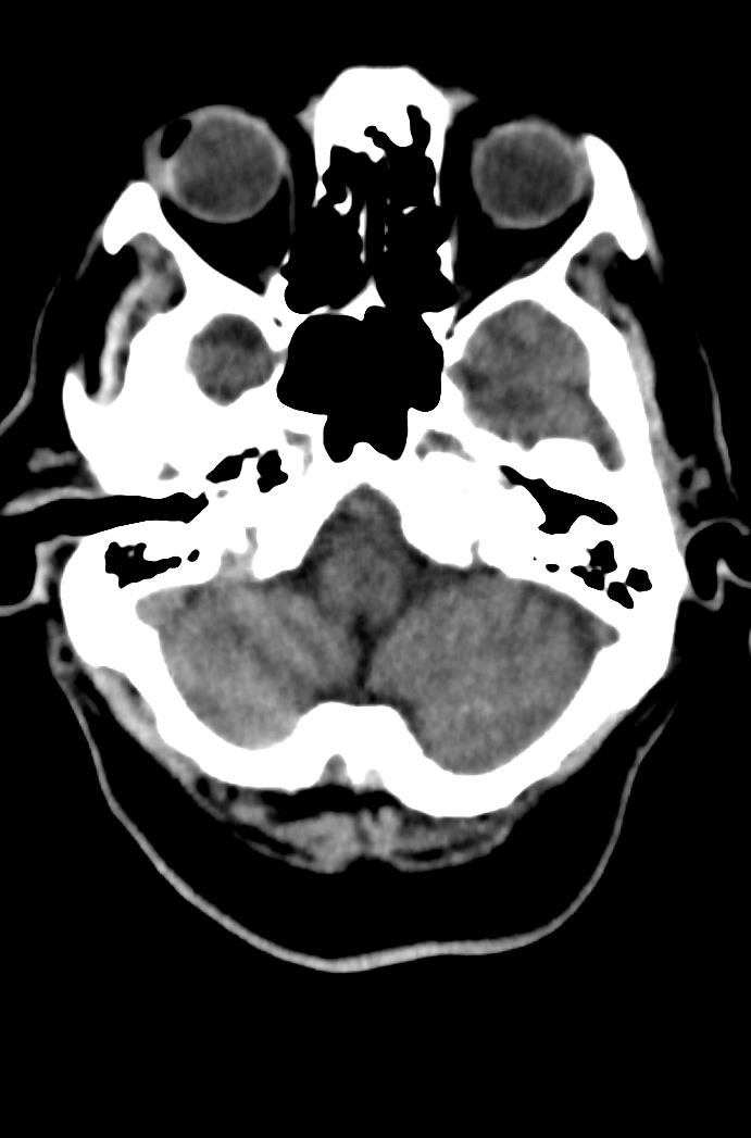 Artery of Percheron infarction (Radiopaedia 80613-94202 Axial non-contrast 43).jpg