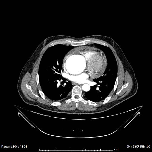 File:Ascending aortic aneurysm (Radiopaedia 50086-55404 A 47).jpg