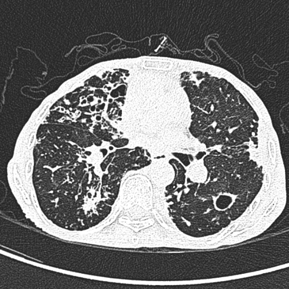 Aspergilloma- with Monod sign (Radiopaedia 44737-48532 Axial lung window 135).jpg