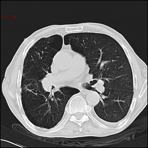 File:Aspergilloma (Radiopaedia 14842-14787 Axial lung window 23).jpg