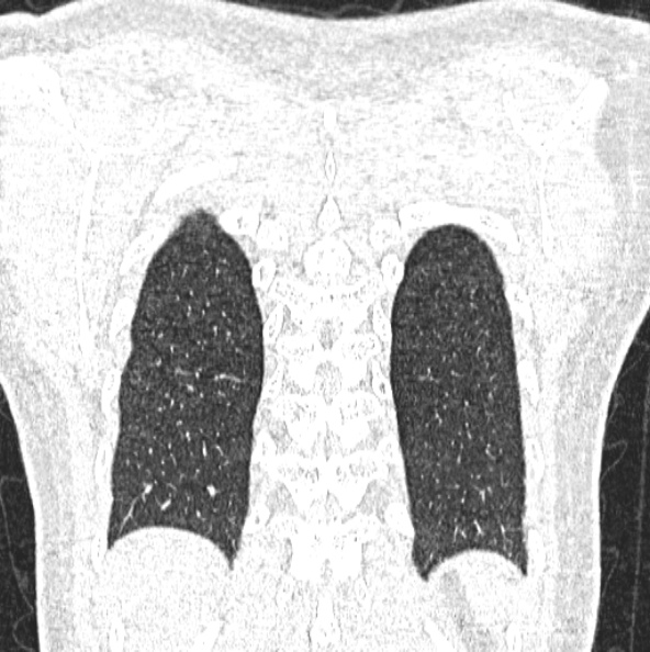 File:Aspergilloma (Radiopaedia 26223-26347 Coronal lung window 47).jpg