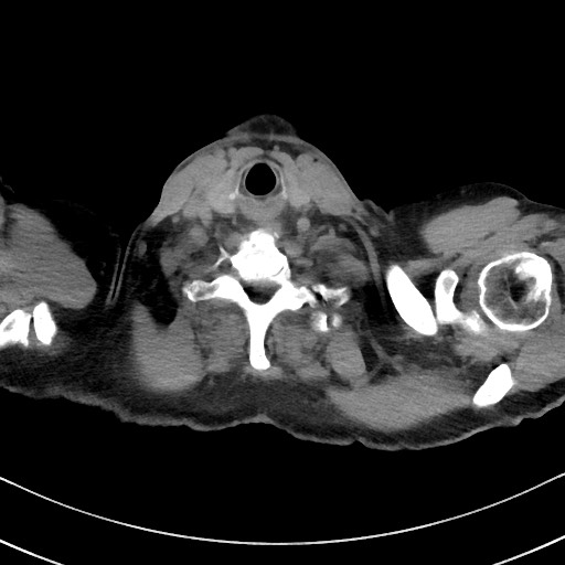 Aspergilloma on background pulmonary fibrosis (Radiopaedia 60942-68757 Axial non-contrast 1).jpg