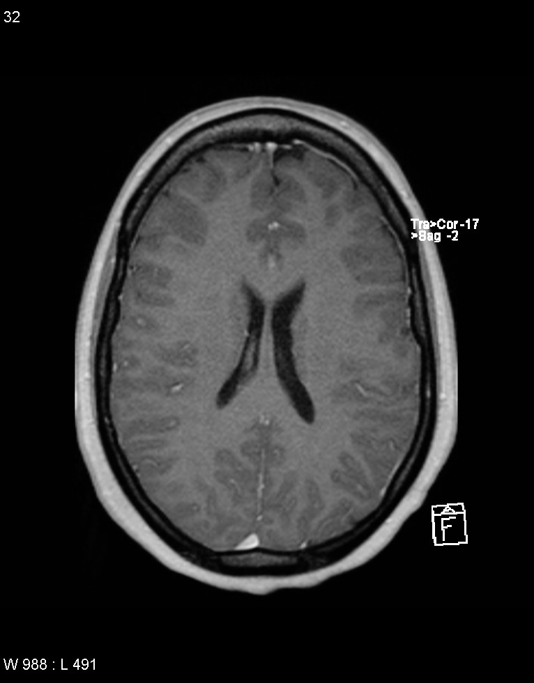 Astroblastoma (Radiopaedia 39792-42217 Axial T1 C+ 31).jpg