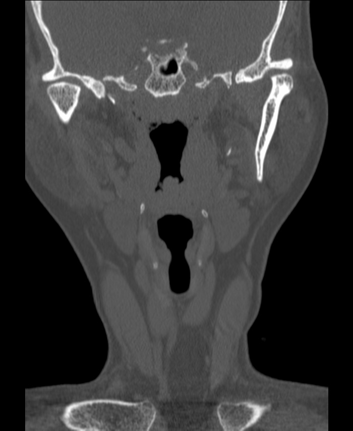 Atlanto-occipital assimilation with basilar invagination (Radiopaedia 70122-80188 Coronal bone window 1).jpg