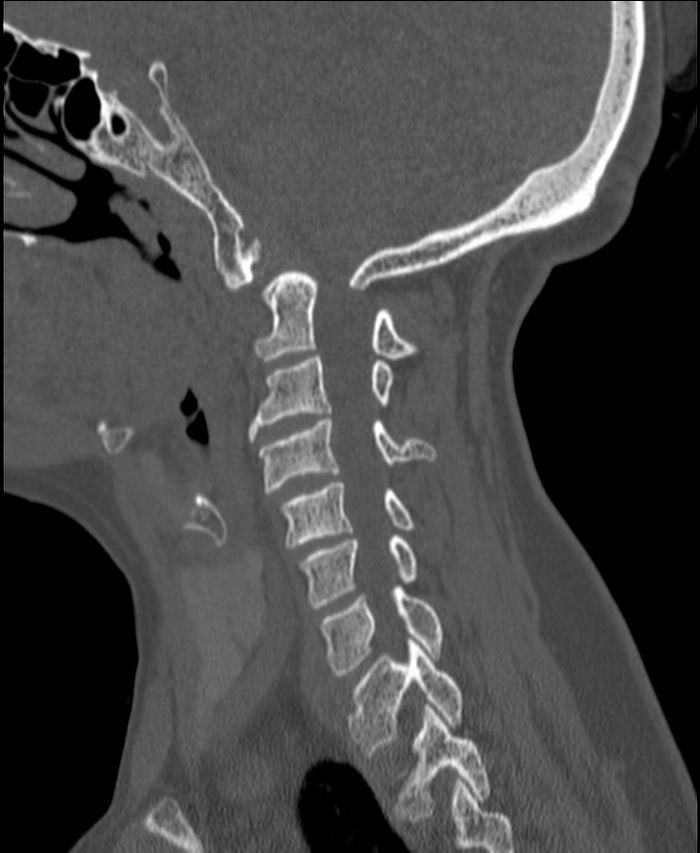 Atlanto-occipital assimilation with basilar invagination (Radiopaedia 70122-80188 Sagittal bone window 36).jpg