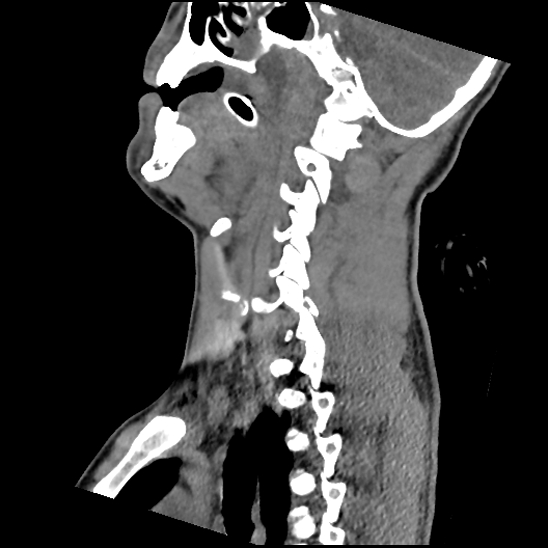 Atlanto-occipital dissociation (Traynelis type 1), C2 teardrop fracture, C6-7 facet joint dislocation (Radiopaedia 87655-104061 D 36).jpg