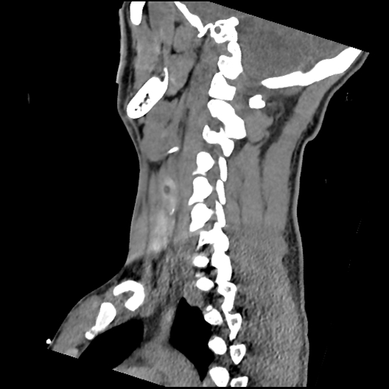 File:Atlanto-occipital dissociation (Traynelis type 1), C2 teardrop fracture, C6-7 facet joint dislocation (Radiopaedia 87655-104061 D 54).jpg