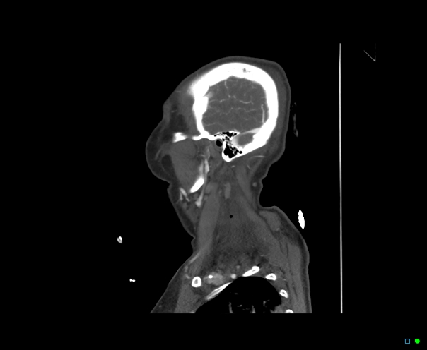 Atlanto-occipital dissociation - Traynelis type 1 (Radiopaedia 87570-103949 C 49).jpg