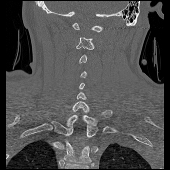 Atlanto-occipital dissociation injury (Radiopaedia 29274-29698 Coronal bone window 14).png
