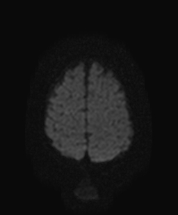 File:Atretic parietal cephalocele (Radiopaedia 64350-73135 Axial DWI 19).jpg