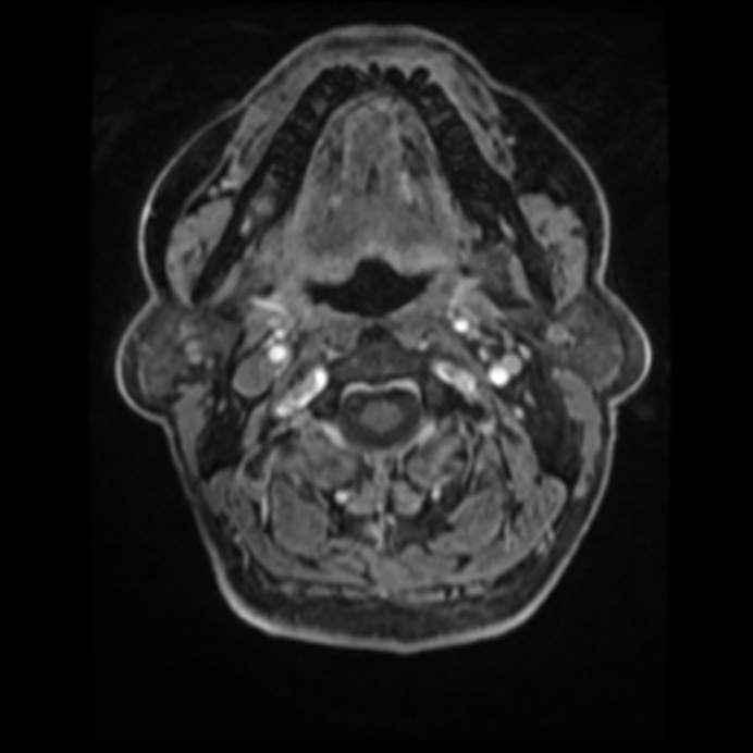Atypical meningioma (Radiopaedia 45535-49629 Axial T1 C+ 6).jpg