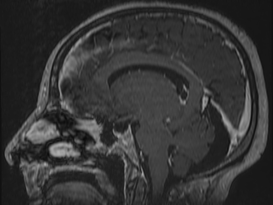 Atypical meningioma (Radiopaedia 62985-71406 Sagittal T1 C+ 47).jpg