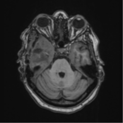 File:Atypical meningioma (WHO Grade II) (Radiopaedia 54742-60981 Axial T1 20).png