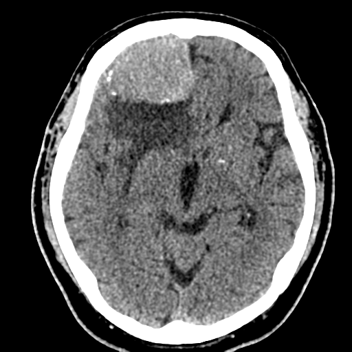 File:Atypical meningioma (WHO grade II) with brain invasion (Radiopaedia 57767-64728 Axial non-contrast 18).png