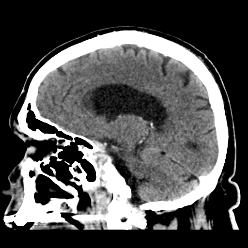 Atypical meningioma (WHO grade II) with brain invasion (Radiopaedia 57767-64728 Sagittal C+ 31).png