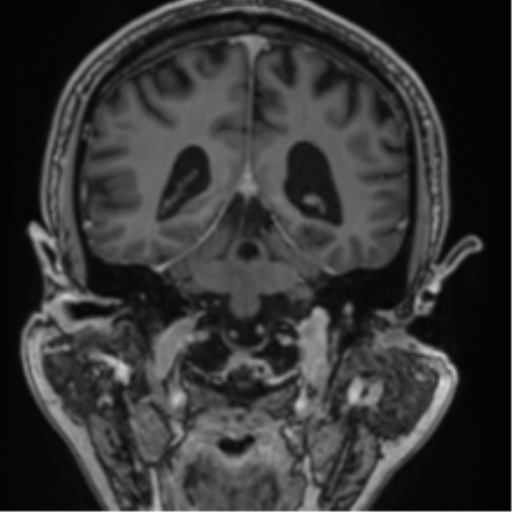 File:Atypical meningioma (WHO grade II) with brain invasion (Radiopaedia 57767-64729 Coronal T1 C+ 54).png