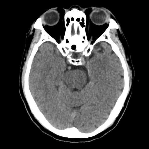 Atypical meningioma (WHO grade II) with osseous invasion (Radiopaedia 53654-59715 Axial non-contrast 20).png