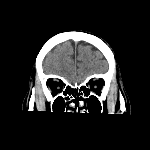 Atypical meningioma (WHO grade II) with osseous invasion (Radiopaedia 53654-59715 Coronal non-contrast 16).png
