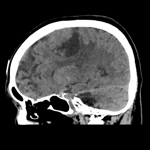 File:Atypical meningioma with skull invasion (Radiopaedia 34357-35649 E 22).png
