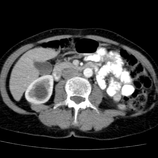 File:Atypical renal cyst (Radiopaedia 17536-17251 renal cortical phase 22).jpg