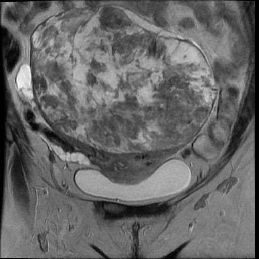 File:Atypical retroperitoneal lymphocoeles with large leiomyoma of uterus (Radiopaedia 32084-33027 Coronal T2 10).jpg