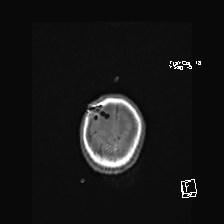 Atypical teratoid rhabdoid tumor (prenatal US and neonatal MRI) (Radiopaedia 59091-66388 Axial T1 52).jpg