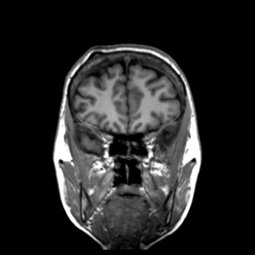 Autoimmune limbic encephalitis (Radiopaedia 30363-31005 Coronal T1 43).jpg