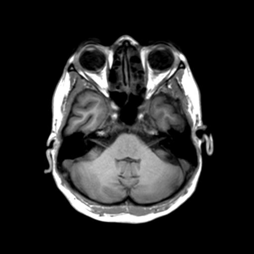 Autoimmune limbic encephalitis (Radiopaedia 30363-31005 T1 Axial 3mm 14).jpg