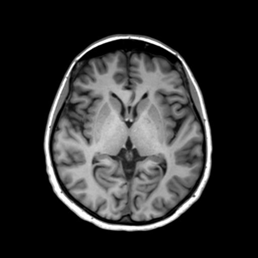 Autoimmune limbic encephalitis (Radiopaedia 30363-31005 T1 Axial 3mm 26).jpg