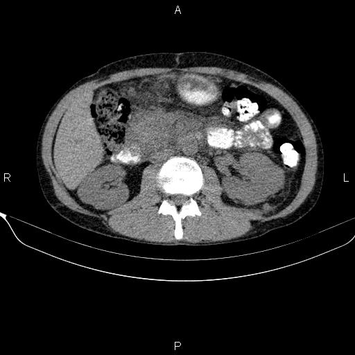 Autoimmune pancreatitis (Radiopaedia 84925-100431 Axial non-contrast 26).jpg