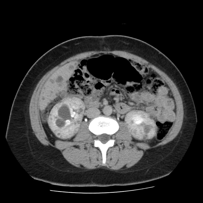 Autosomal dominant polycystic kidney disease (Radiopaedia 23061-23093 C+ delayed 37).jpg
