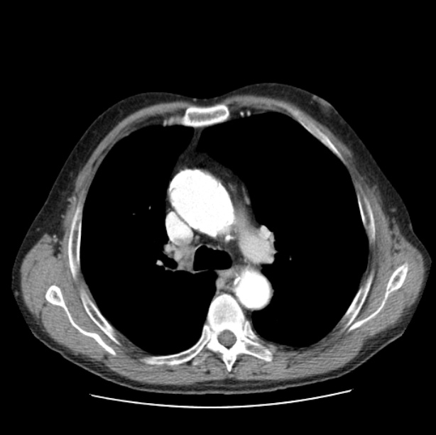 Autosomal dominant polycystic kidney disease (Radiopaedia 27851-28094 B 23).jpg