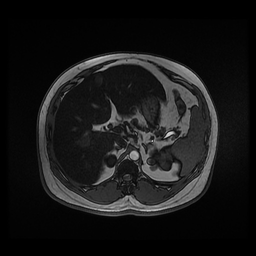 Autosomal dominant polycystic kidney disease (Radiopaedia 50259-55611 Axial 2D Dual Echo 31).jpg