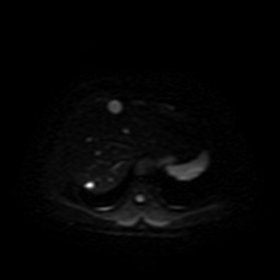 File:Autosomal dominant polycystic kidney disease (Radiopaedia 50259-55611 Axial DWI 6).jpg