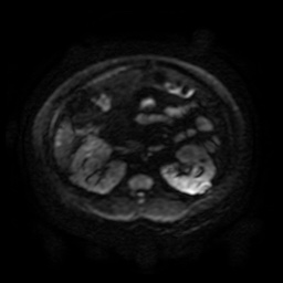 File:Autosomal dominant polycystic kidney disease (Radiopaedia 50259-55611 Axial DWI 94).jpg