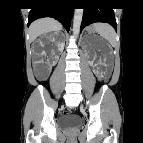 Autosomal dominant polycystic kidney disease (Radiopaedia 66349-75582 A 57).jpg