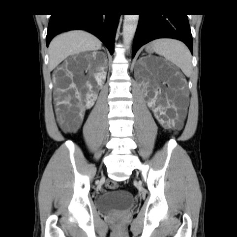 Autosomal dominant polycystic kidney disease (Radiopaedia 66349-75582 A 59).jpg