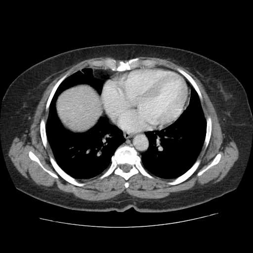 File:Autosomal dominant polycystic kidney disease with hepatic involvement (Radiopaedia 32693-33662 B 4).jpg